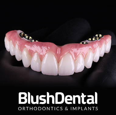 Hybrid Implant Bridge