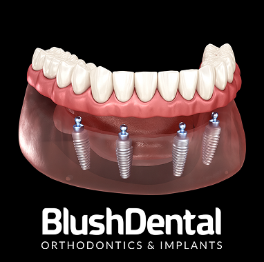 Zirconia Implant Bridge